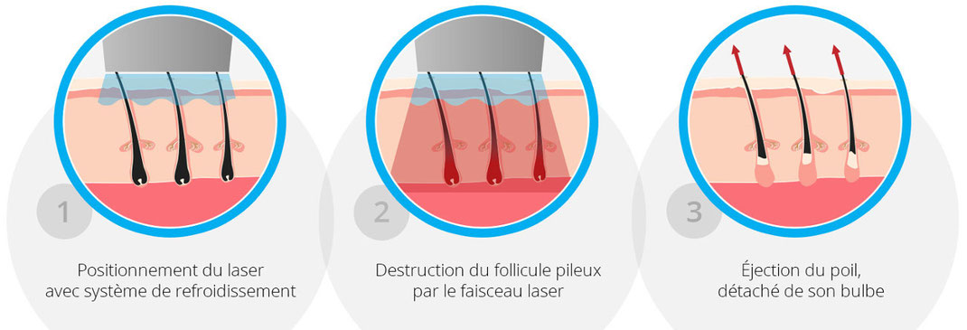 Différence entre l'épilation au laser et l'épilation à la lumière pulsée -  LAZEO