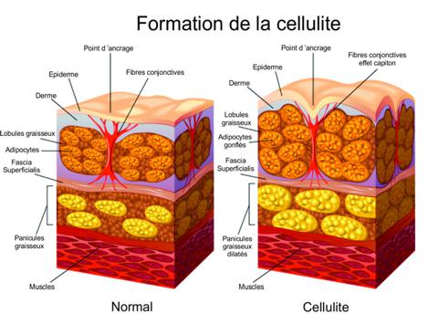 Formation de la cellulite Formation de la cellulite