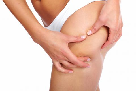 Cellulite type peau d'orange sur la cuisse Cellulite
